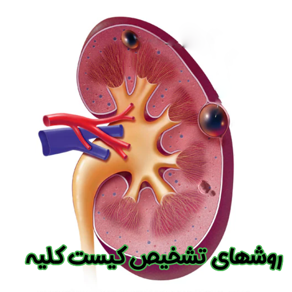 روشهای تشخیص کیست کلیه