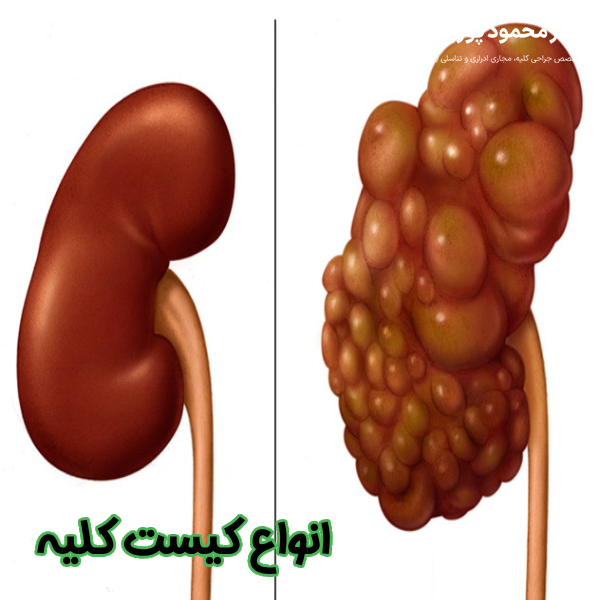 انواع کیست کلیه