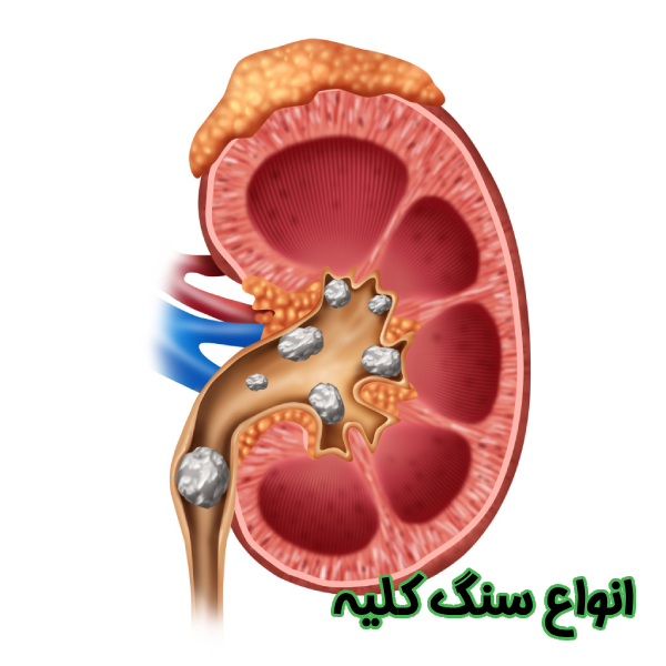 انواع سنگ کلیه