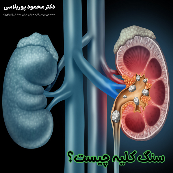 سنگ کلیه چیست