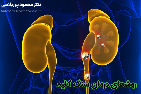روشهای درمان سنگ کلیه