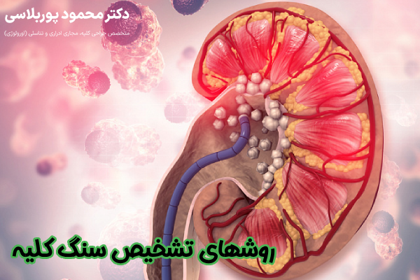 روشهای تشخیص سنگ کلیه