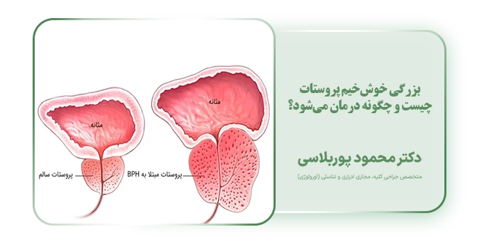 بزرگی خوش‌خیم پروستات چیست و چگونه درمان می‌شود