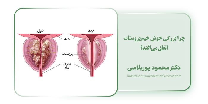 چرا بزرگی خوش خیم پروستات اتفاق می‌افتد؟