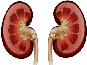 درمان سنگ کلیه بدون جراحی