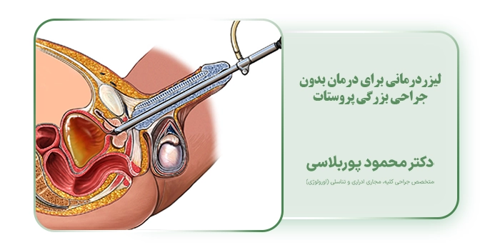 لیزردرمانی برای درمان بدون جراحی بزرگی پروستات
